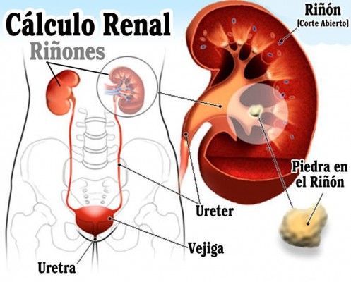 10 Remedios naturales para las piedras en los riñones (cálculos renales)